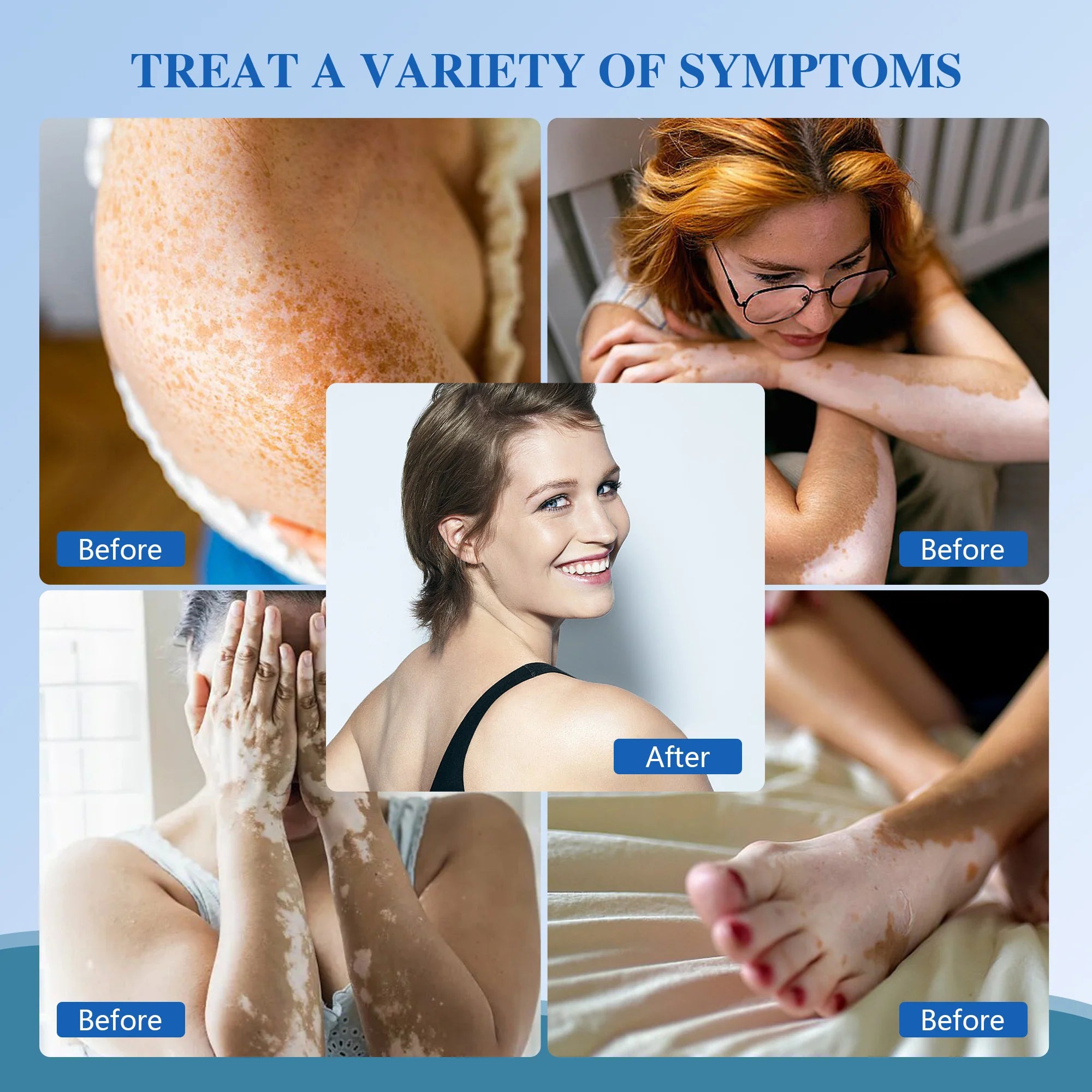 Handheld UVB Phototherapy Device for Vitiligo & Psoriasis - Portable 308nm Light Therapy Lamp by UVBtreatment