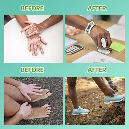 UVBtreatment Targeted Narrowband UVB Therapy Device