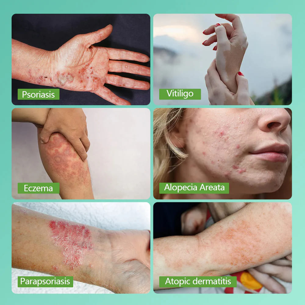 UVBtreatment Targeted Narrowband UVB Therapy Device